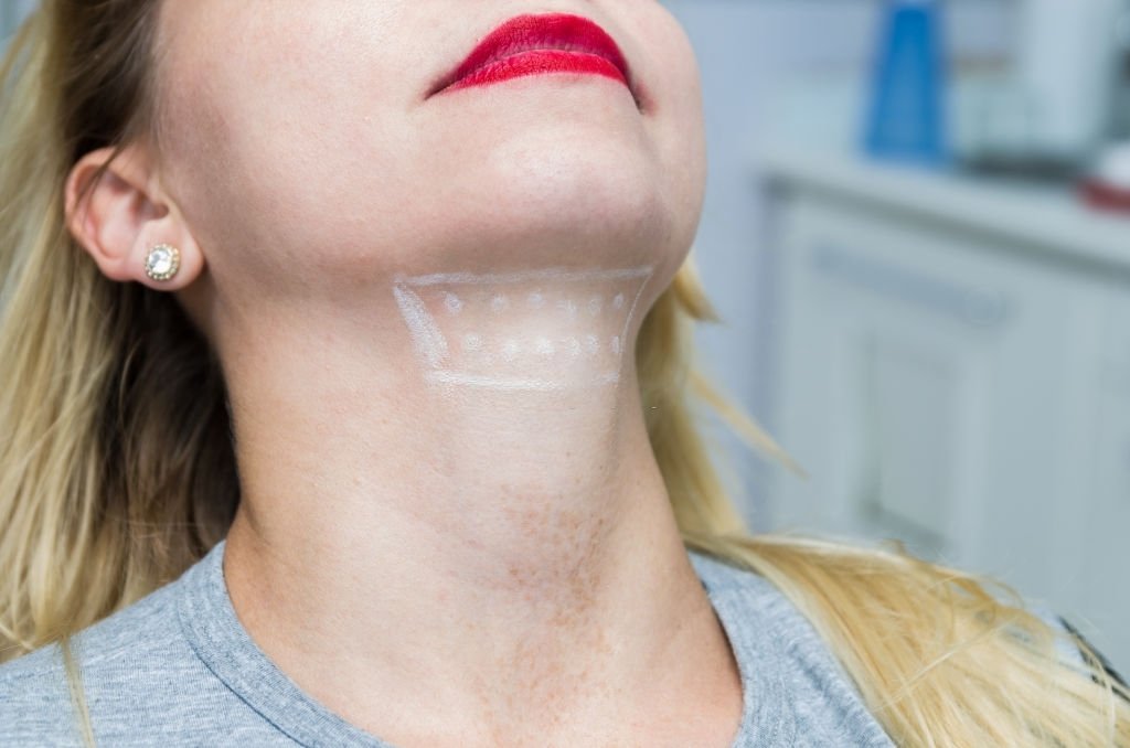 How to Get Rid of a Double Chin & Jowls Fast